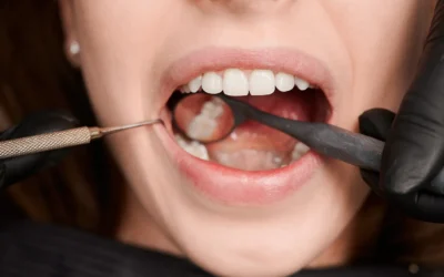 Diş Taşı Temizliği Nasıl Yapılır?
